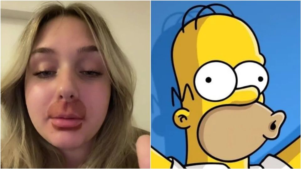 Joven se gana el apodo de “Homero Simpson” tras someterse a procedimiento estético de labios