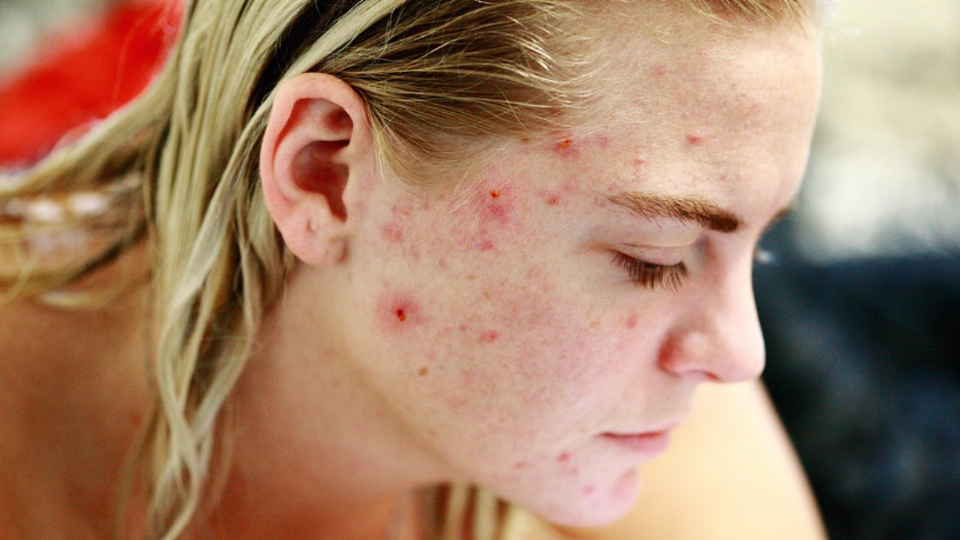7 remedios caseros que te ayudarán a tratar el acné