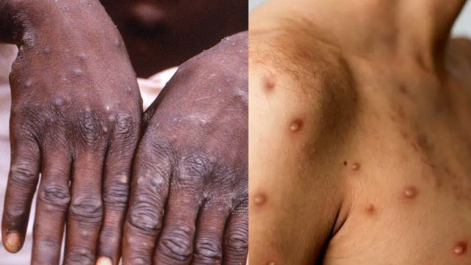 Revela estudio que 95% de los casos de viruela del mono se transmitieron por actividad sexual